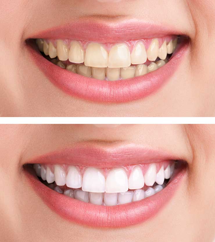 wy10 tooth whitening from Eagle Dental Practice Liphook 